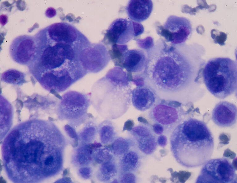 Neues aus der Lungenkrebs-Pipeline – Erste zielgerichtete Substanz bei KRAS-Mutation und bispezifische Immuntherapie