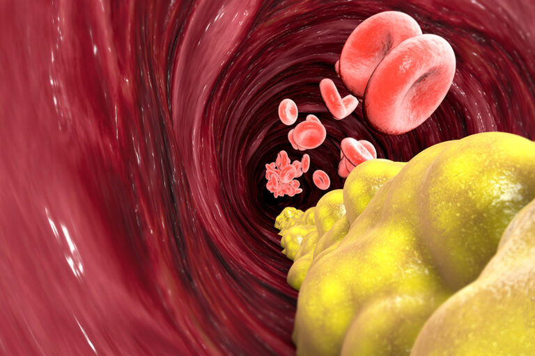 Hypercholesterinämie – Effektive LDL-Cholesterin Senkung mit nur zwei Injektionen jährlich