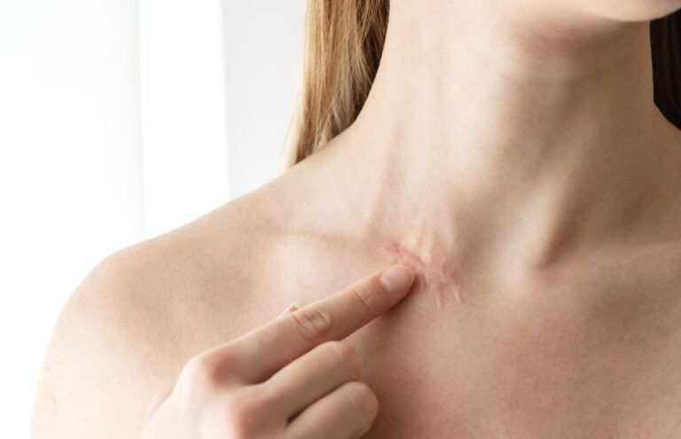Nicht-invasive Narbenbehandlung mit modernster Lasertechnologie