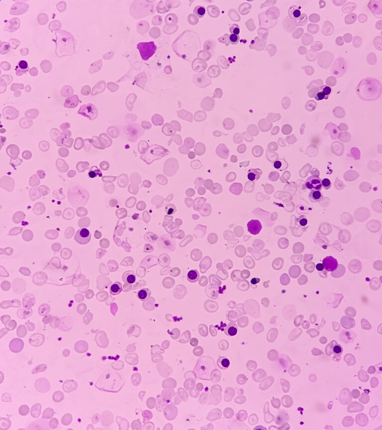 Autoimmunerkrankungen als Ursache für Anämien