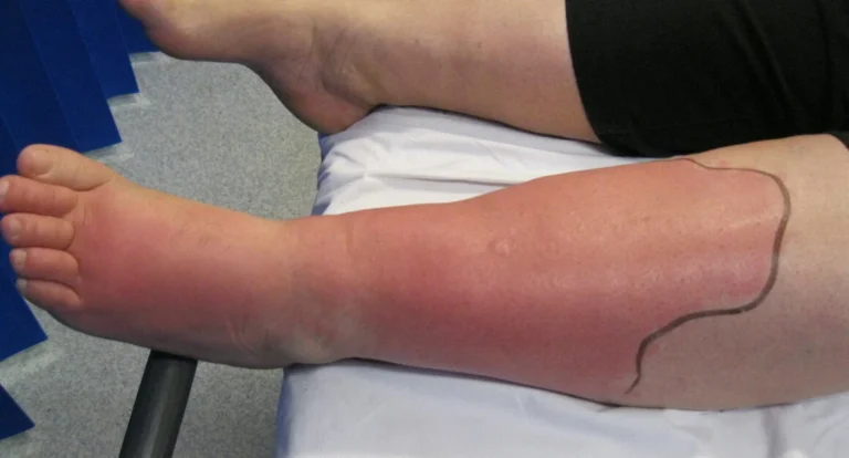 Erysipel und Zellulitis: wichtige «Hot Topics»