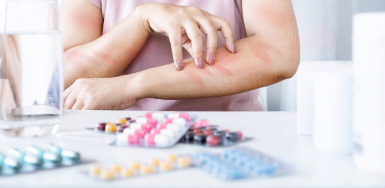 DRESS-Syndrom – Aktuelles zu Diagnostik und Therapie