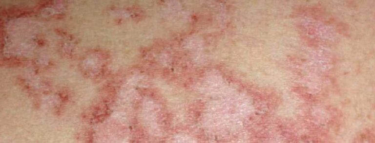 Erkenntnisse aus der «Leeds SLE Inception Cohort»