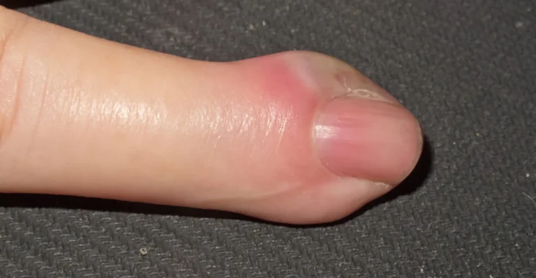 Viral, bakteriell oder mykotisch?