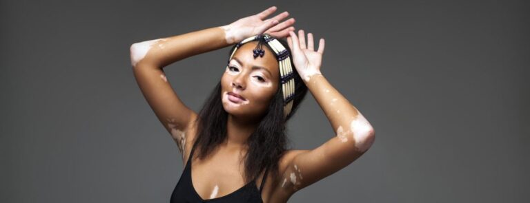 Vitiligo: Krankheitslast und Versorgungsbedarf